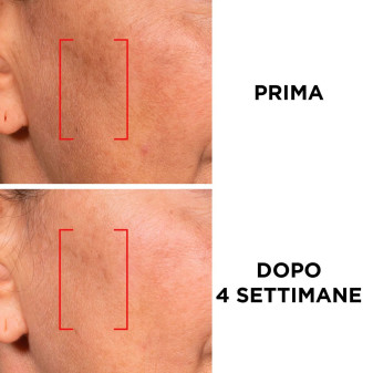 Revitalift Laser Crema Giorno Anti-Età SPF 25 L'Oréal Paris